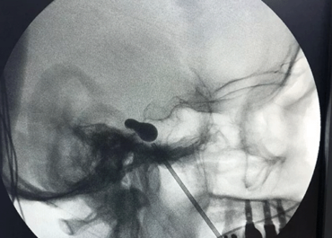 Compressão do Nervo Trigêmeo para Neuralgia Trigeminal